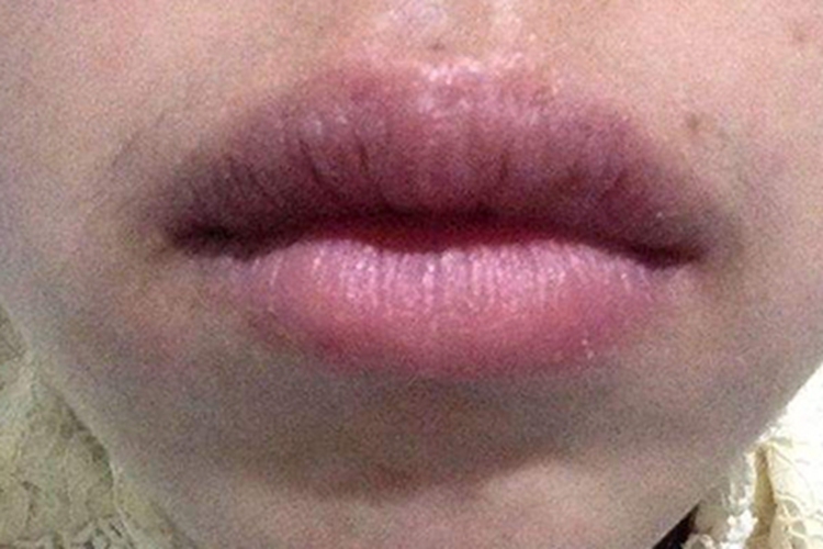 变应性接触性唇炎肿图