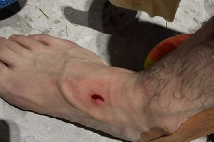 脚背静脉破裂出血图