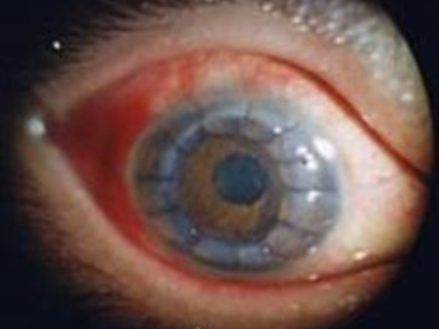 新生血管性青光眼房角关闭期眼睛红肿图.jpg