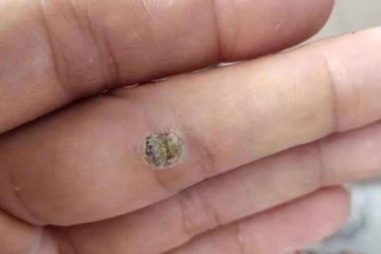 疣手部点状结痂图