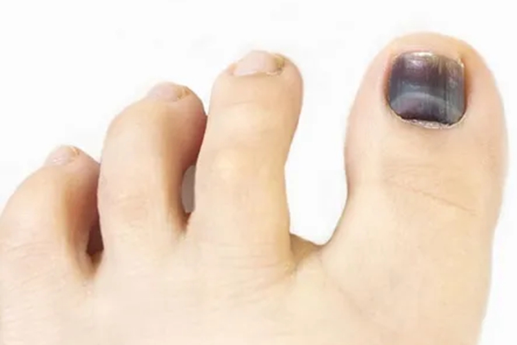 脚趾甲盖里面有淤血的图
