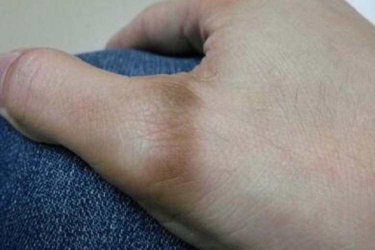 大拇指根部发黑图 大拇指根部发黑图