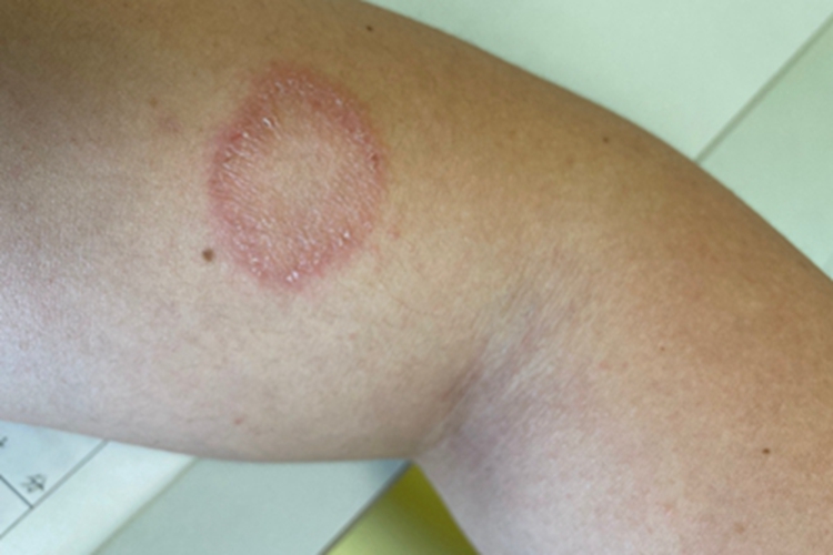 体癣胳膊环形红斑脱屑图