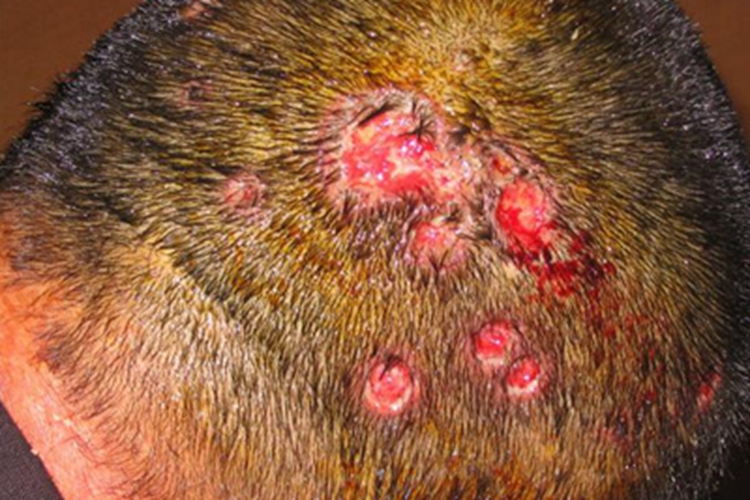 脓窝疮长坑图 脓窝疮长坑图