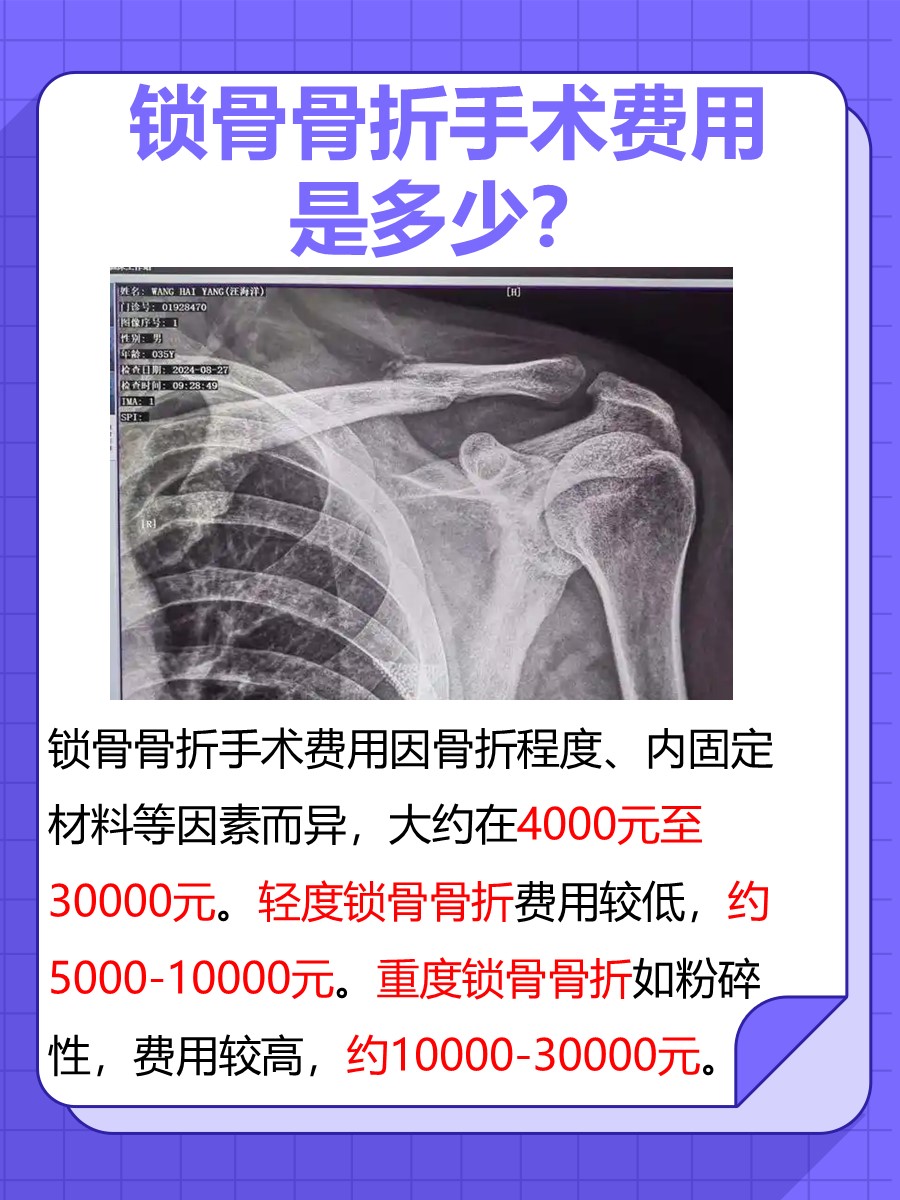 揭晓：锁骨骨折手术费用需要多少钱？
