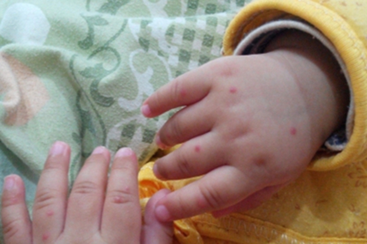 手足口病手部红点图