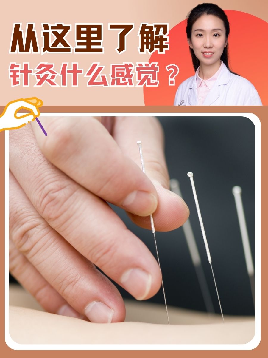 从这里了解：针灸什么感觉？