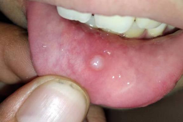 下嘴唇内溃疡图
