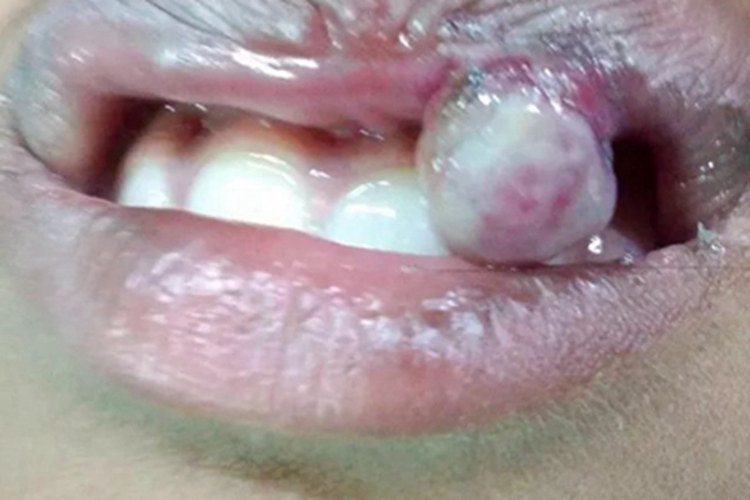 化脓性肉芽肿肉球图