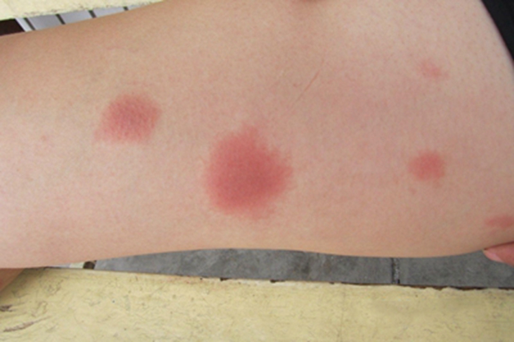 固定型药疹小腿红斑图