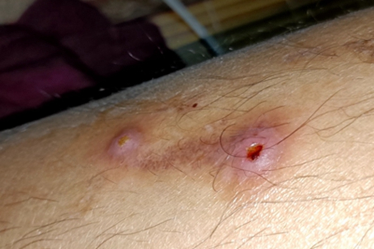 毛囊炎小腿小红疙瘩图 毛囊炎小腿小红疙瘩图