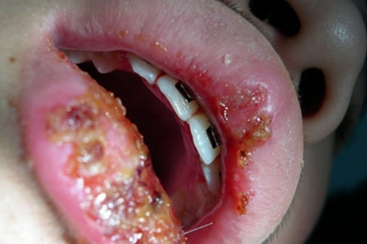 类脂蛋白沉积症嘴唇结痂图