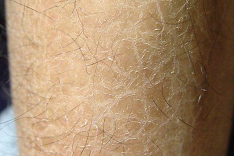 毛囊性鱼鳞病小腿脱屑图 毛囊性鱼鳞病小腿脱屑图