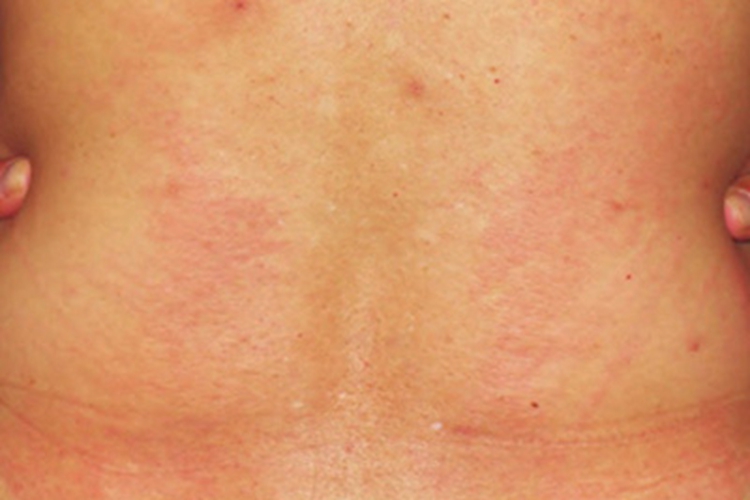 疱疹样皮炎背部红斑图