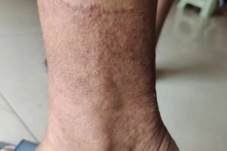 体癣脚踝处有一片褐色疹子图