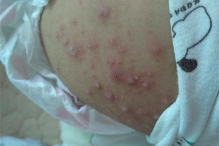 手足口病屁股上有好多疙瘩图 手足口病屁股上有好多疙瘩图