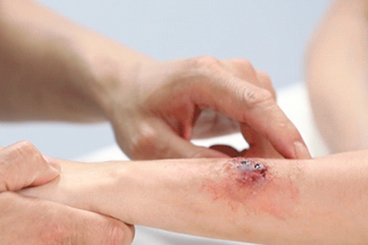 海蛇咬伤症状图 海蛇咬伤症状图