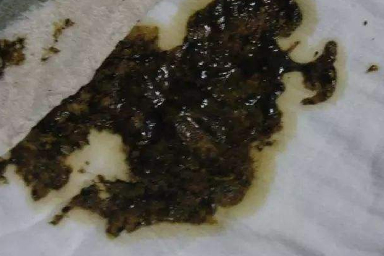 坏死性肠炎婴儿大便粘稠稀糊状图