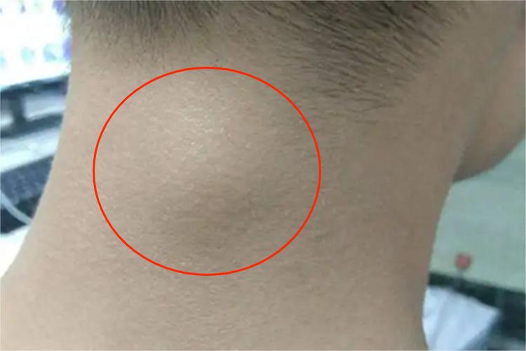 颈部纤维瘤后颈症状图