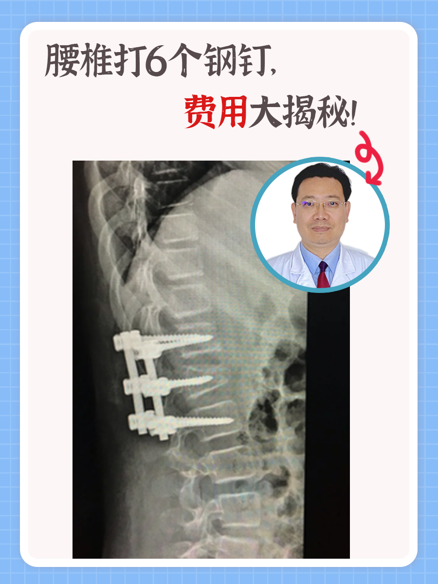 腰椎打6个钢钉,费用大揭秘!
