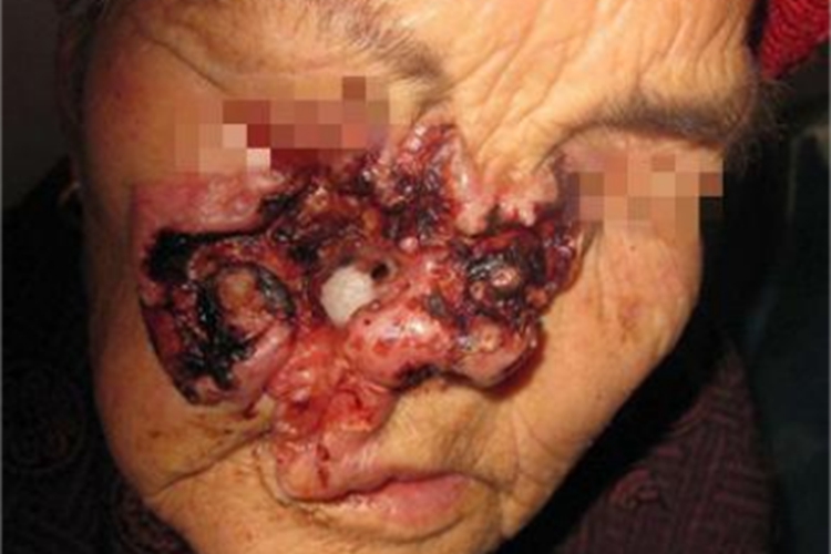 基底细胞瘤大坑图 基底细胞瘤大坑图