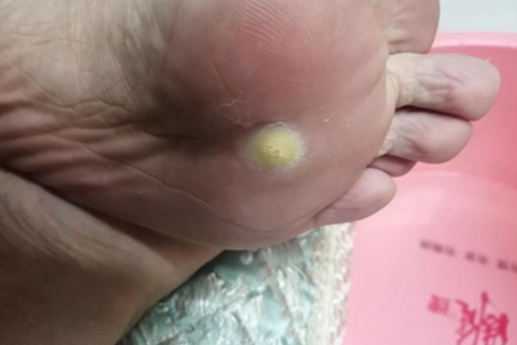 胼胝脚底有个黄色厚茧子图