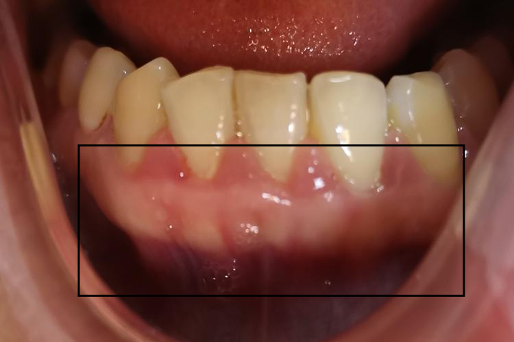 青春期龈炎牙龈增生图 青春期龈炎牙龈增生图