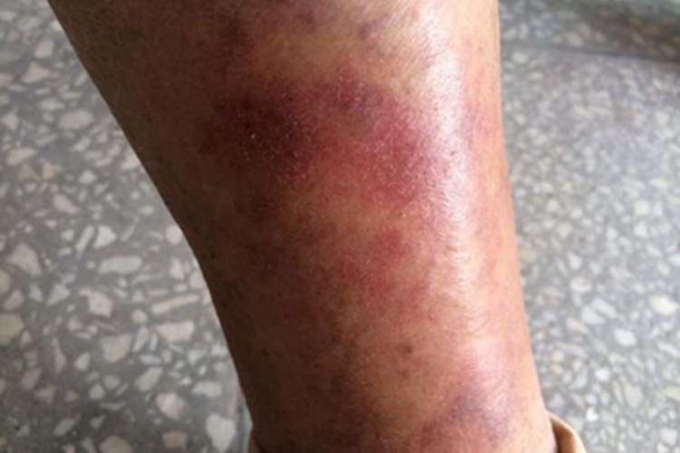 淤积性皮炎粗糙图