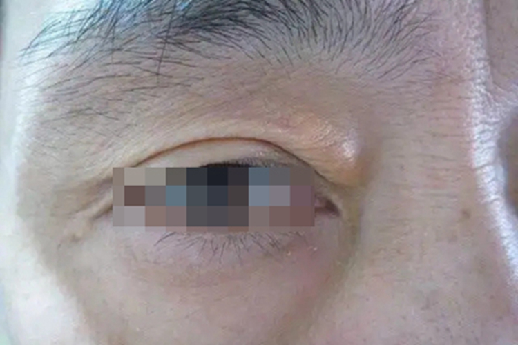 睑黄瘤眼角结节图 睑黄瘤眼角结节图