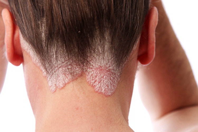 红皮病脱屑期后脑勺红斑图