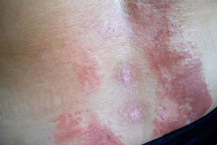 过敏性皮炎腰部症状图