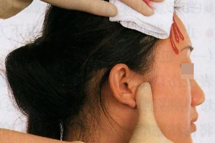 直接按压伤处止血图