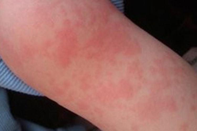 接触性荨麻疹胳膊风团图 接触性荨麻疹胳膊风团图