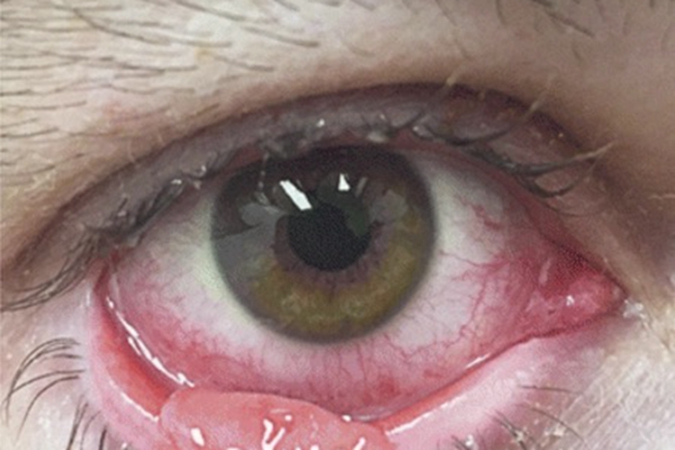 结膜乳头状瘤结膜症状图 结膜乳头状瘤结膜症状图