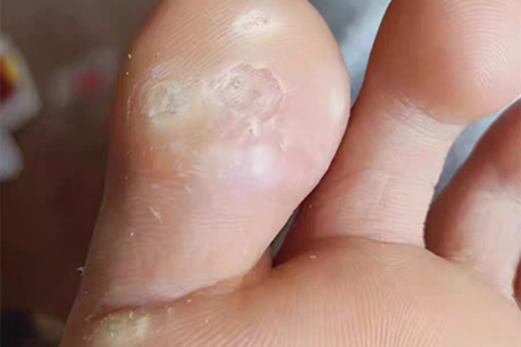 胼胝脚趾坑图 胼胝脚趾坑图