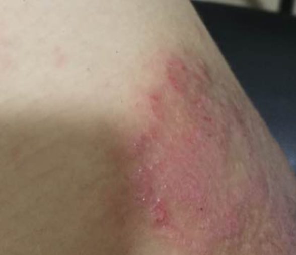 女性大腿根部急性湿疹图