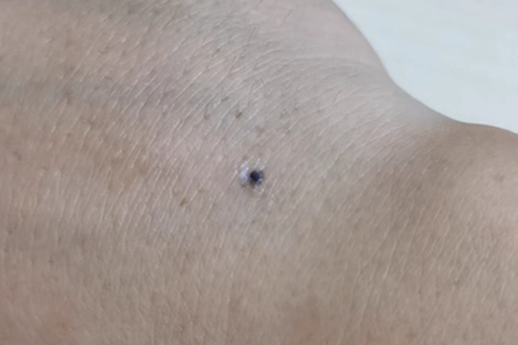 交界痣手背有黑色疙瘩图