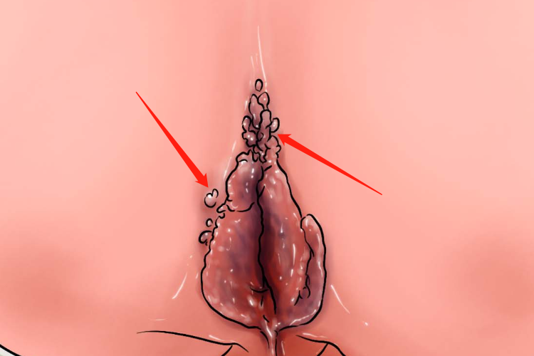 女性尖锐湿疣图 女性尖锐湿疣图