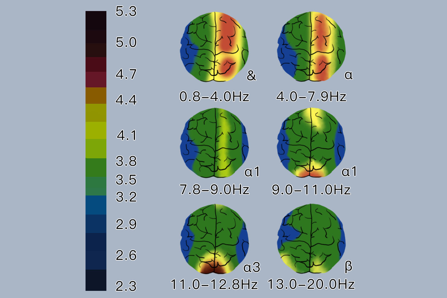 普遍性轻度异常脑电地形图 普遍性轻度异常脑电地形图