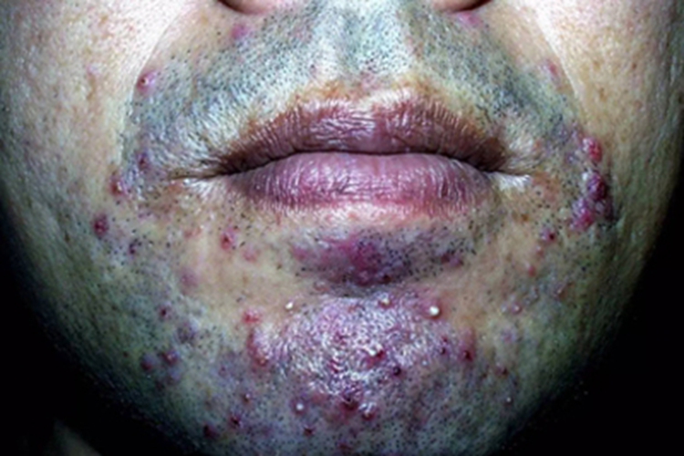 须疮口周症状图