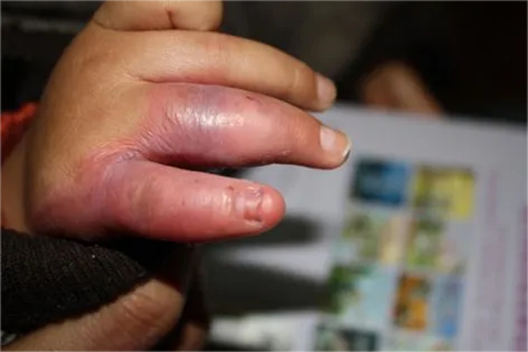 一度烫伤手指症状图