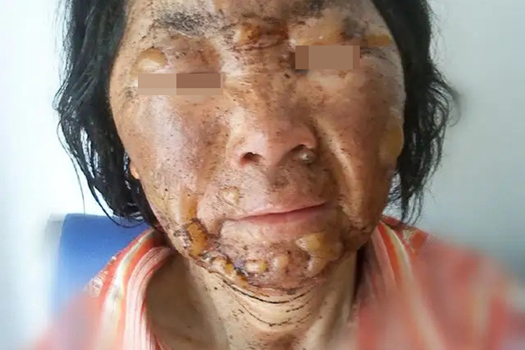 脸部Ⅲ度烧伤图 脸部Ⅲ度烧伤图