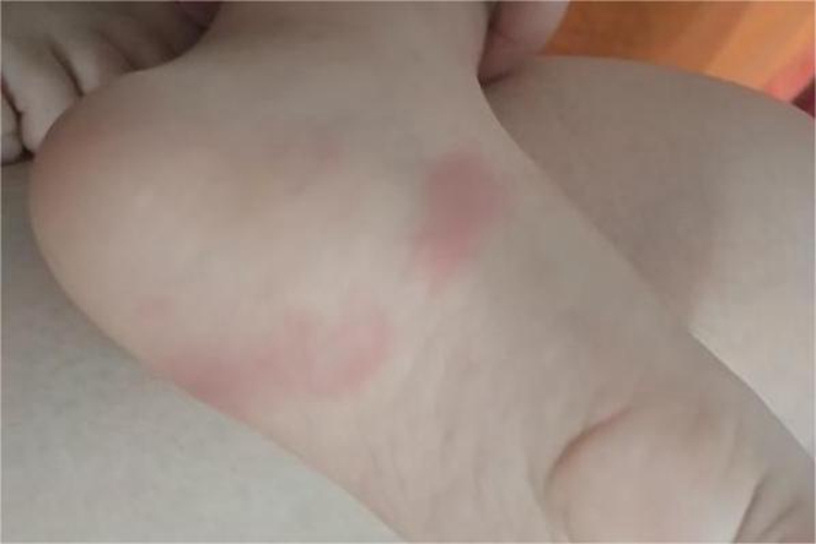 虫咬皮炎脚底红斑图