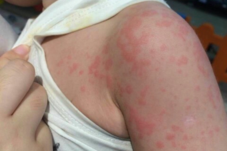 亚急性接触性皮炎肩部红斑图