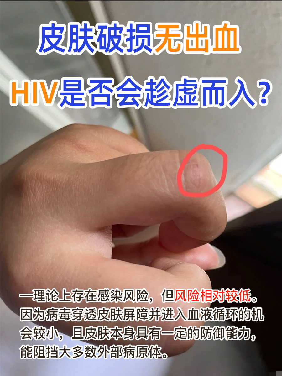 皮肤破损无出血,HIV是否会趁虚而入?