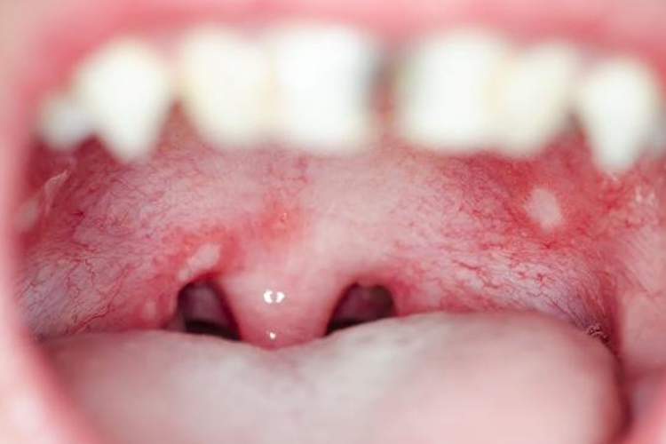 轻型口腔溃疡图 轻型口腔溃疡图