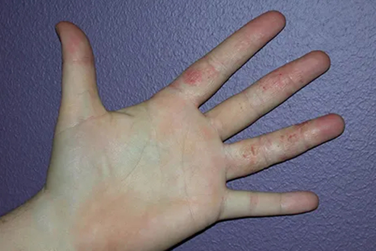 粉笔过敏手指红斑糜烂图
