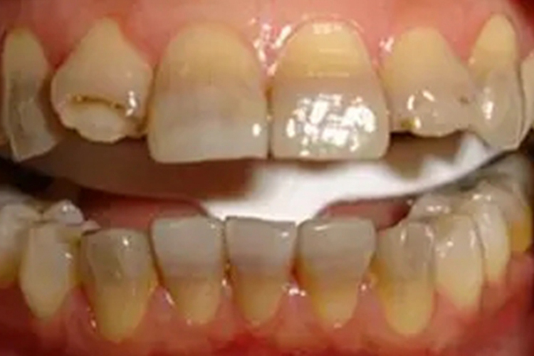 重度四环素着色图 重度四环素着色图