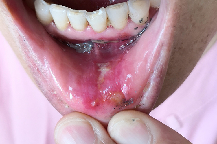 艾滋病口腔单纯疱疹图 艾滋病口腔单纯疱疹图