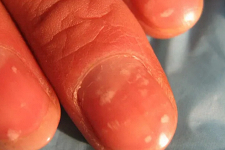 点状白甲手指甲症状图